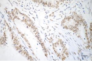 Immunohistochemistry was performed on paraffin-embedded human sigmoid colon carcinoma using USP39 antibody (ABIN7800735), 1:200). (Recombinant USP39 抗体)