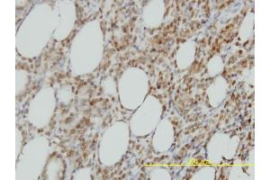 Immunoperoxidase of monoclonal antibody to ISGF3G on formalin-fixed paraffin-embedded human malignant lymphoma, diffuse large B tissue. (IRF9 抗体  (AA 1-393))