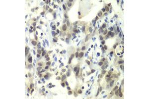 Immunohistochemistry of paraffin-embedded human gastric cancer using E2F6 antibody. (E2F6 抗体)