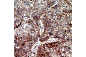 Immunohistochemical analysis of CD208 staining in human lung cancer formalin fixed paraffin embedded tissue section. (LAMP3 抗体)