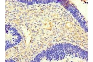 Immunohistochemistry of paraffin-embedded human ovarian cancer using ABIN7143204 at dilution of 1:100 (ACSF3 抗体  (AA 365-484))