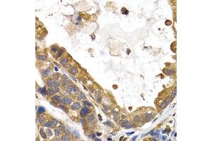 Immunohistochemistry of paraffin-embedded human stomach cancer using GYS1 antibody (ABIN5971351) at dilution of 1/200 (40x lens). (Glycogen Synthase 1 抗体)