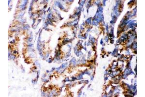 IHC analysis of Cathepsin D using anti-Cathepsin D antibody (ABIN3044509). (Cathepsin D 抗体  (AA 201-412))