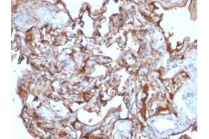 Formalin-fixed, paraffin-embedded human Melanoma stained with MCAM Mouse Monoclonal Antibody (MCAM/1101). (MCAM 抗体)