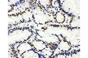 IHC-P: HDAC3 antibody testing of human intestinal cancer tissue (HDAC3 抗体  (AA 411-428))