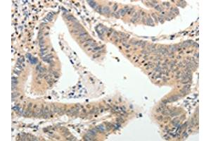 The image on the left is immunohistochemistry of paraffin-embedded Human colon cancer tissue using ABIN7189660(ADAMTS2 Antibody) at dilution 1/25, on the right is treated with synthetic peptide. (Adamts2 抗体)