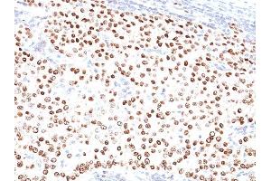 Formalin-fixed, paraffin-embedded human Breast Carcinoma stained with Progesterone Receptor Mouse Monoclonal Antibody (PR500). (Progesterone Receptor 抗体)