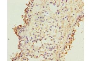 Immunohistochemistry of paraffin-embedded human breast cancer using ABIN7157640 at dilution of 1:100 (KIF26B 抗体  (AA 8-133))