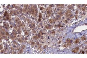 ABIN6276849 at 1/100 staining Human liver cancer tissue by IHC-P. (CHRNA5 抗体  (Internal Region))