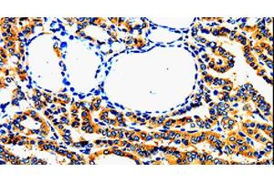 Immunohistochemistry of paraffin-embedded Human thyroid cancer using AIMP2 Polyclonal Antibody at dilution of 1:50 (AIMP2 抗体)
