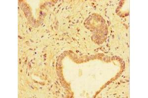 Immunohistochemistry of paraffin-embedded human prostate cancer using ABIN7173659 at dilution of 1:100 (TUBA1C 抗体  (AA 29-184))