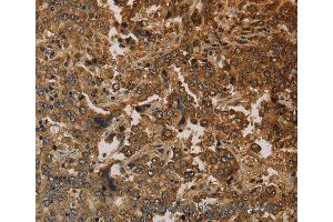Immunohistochemistry of Human liver cancer using KRT16 Polyclonal Antibody at dilution of 1:30 (KRT16 抗体)