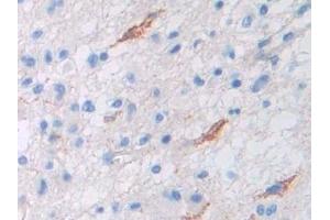 Detection of Pgp in Human Glioma Tissue using Polyclonal Antibody to Permeability Glycoprotein (Pgp) (Permeability Glycoprotein 抗体  (AA 394-672))