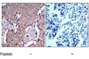 Immunohistochemical analysis of paraffin-embedded human breast carcinoma tissue using ERBB2 polyclonal antibody  . (ErbB2/Her2 抗体)