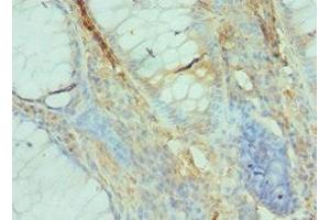 Immunohistochemistry of paraffin-embedded human colon cancer using ABIN7152531 at dilution of 1:100 (GFER 抗体  (AA 81-205))