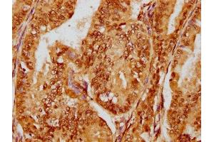 IHC image of ABIN7127500 diluted at 1:180 and staining in paraffin-embedded human endometrial cancer performed on a Leica BondTM system. (Recombinant FOXO3 抗体)
