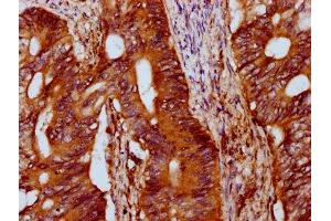 IHC image of ABIN7156973 diluted at 1:400 and staining in paraffin-embedded human colon cancer performed on a Leica BondTM system. (IFT172 抗体  (AA 1368-1502))