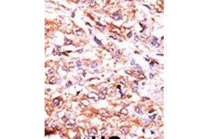 Formalin-fixed and paraffin-embedded human cancer tissue reacted with the primary antibody, which was peroxidase-conjugated to the secondary antibody, followed by AEC staining. (GUCY1A2 抗体  (N-Term))
