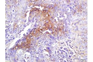 Formalin-fixed and paraffin embedded human laryngeal tissue labeled with Rabbit Anti-eIF4H Polyclonal Antibody, Unconjugated (ABIN2559623) at 1:200 followed by conjugation to the secondary antibody and DAB staining (EIF4H 抗体  (AA 31-130))
