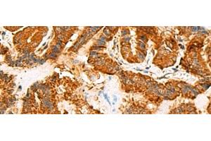 Immunohistochemistry of paraffin-embedded Human thyroid cancer tissue using ASMTL Polyclonal Antibody at dilution of 1:100(x200) (ASMTL 抗体)