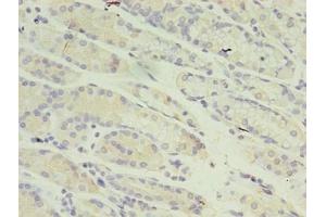 Immunohistochemistry of paraffin-embedded human gastric cancer using ABIN7150974 at dilution of 1:100 (RANBP2 抗体  (AA 2601-2802))