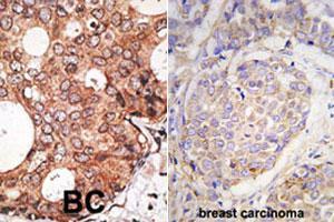 Formalin-fixed and paraffin-embedded human breast carcinoma tissue reacted with MAGEA10 polyclonal antibody  , which was peroxidase-conjugated to the secondary antibody, followed by DAB staining. (MAGEA10 抗体  (C-Term))