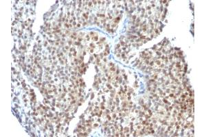 Formalin-fixed, paraffin-embedded human Bladder Carcinoma stained with ER-beta Mouse Monoclonal Antibody (ESR2/686). (ESR2 抗体  (C-Term))