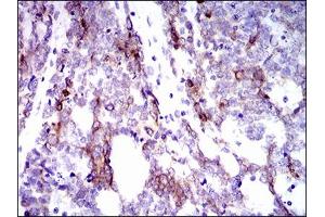 Immunohistochemical analysis of paraffin-embedded esophageal cancer tissues using CK5 mouse mAb with DAB staining.