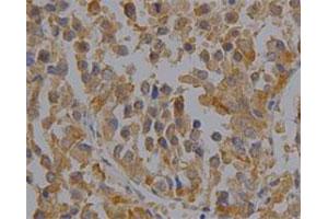 Immunohistochemical staining of human liver cancer tissue section with PRDX6 monoclonal antibody, clone 36  at 1:100 dilution. (Peroxiredoxin 6 抗体)
