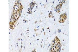 Immunohistochemistry of paraffin-embedded Human breast cancer using CIRBP Polyclonal Antibody at dilution of 1:100 (40x lens). (CIRBP 抗体)