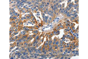 Immunohistochemistry of Human ovarian cancer using CLDN1 Polyclonal Antibody at dilution of 1:150 (Claudin 1 抗体)