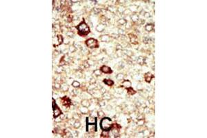 Formalin-fixed and paraffin-embedded human hepatocellular carcinoma tissue reacted with FGFR4 polyclonal antibody  , which was peroxidase-conjugated to the secondary antibody, followed by AEC staining. (FGFR4 抗体  (N-Term))
