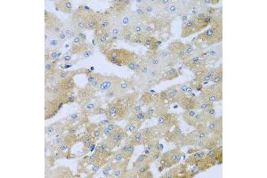 Immunohistochemistry of paraffin-embedded human liver injury using AP1M2 antibody at dilution of 1:100 (x40 lens).