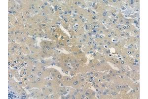 CRACR2A Antibody at 1/100 staining human hepatocellular carcinoma by IHC-P.