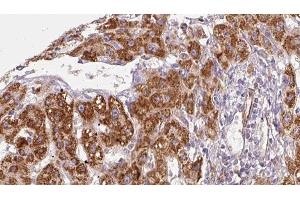 ABIN6279060 at 1/100 staining Human liver cancer tissue by IHC-P. (ACVR2B 抗体  (Internal Region))