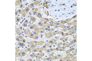 Immunohistochemistry of paraffin-embedded human liver cancer using GFM1 antibody. (GFM1 抗体  (AA 482-751))