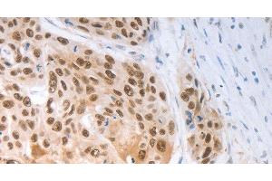 Immunohistochemistry of paraffin-embedded Human ovarian cancer tissue using SLC22A8 Polyclonal Antibody at dilution 1:70 (SLC22A8 抗体)