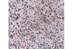 IHC-P analysis of stomach cancer tissue, with DAB staining. (OAS1 抗体  (AA 74-165))