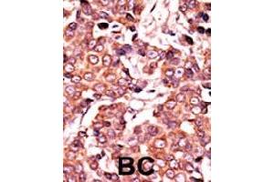 Formalin-fixed and paraffin-embedded human cancer tissue reacted with CDC25A (phospho S278) polyclonal antibody  which was peroxidase-conjugated to the secondary antibody followed by AEC staining. (CDC25A 抗体  (pSer279))