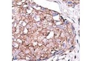IHC analysis of FFPE human hepatocarcinoma stained with the SIGLEC7 antibody (SIGLEC7 抗体  (AA 407-438))