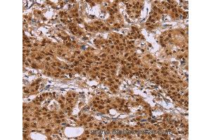 Immunohistochemistry of Human liver cancer using CTNNBL1 Polyclonal Antibody at dilution of 1:50 (CTNNBL1 抗体)