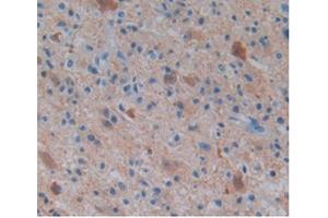 IHC-P analysis of Human Glioma Tissue, with DAB staining. (ENO2/NSE 抗体  (AA 1-434))