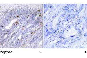 Immunohistochemical analysis of paraffin-embedded human colon carcinoma tissue using NR4A1 polyclonal antibody . (NR4A1 抗体)