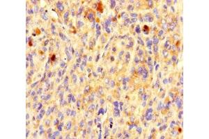 Immunohistochemistry of paraffin-embedded human melanoma using ABIN7162191 at dilution of 1:100 (OR5L1 抗体  (AA 161-196))