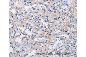 Immunohistochemistry of Human thyroid cancer using ATP6AP2 Polyclonal Antibody at dilution of 1:50 (ATP6AP2 抗体)