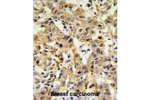 CA6 Antibody (C-term) IHC analysis in formalin fixed and paraffin embedded breast carcinoma followed by peroxidase conjugation of the secondary antibody and DAB staining. (CA6 抗体  (C-Term))