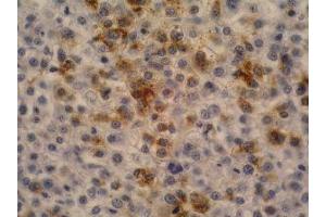 Immunohistochemistry of paraffin-embedded sections (hepatocellular carcinoma) Immunohistochemistry staining of hepatocellular carcinoma (fetal liver; paraffin-embedded sections) with anti-human alpha-Fetoprotein (AFP-11). (alpha Fetoprotein 抗体)