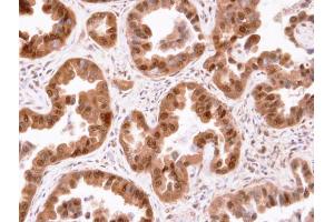 IHC-P Image Immunohistochemical analysis of paraffin-embedded human lung cancer, using CIS, antibody at 1:100 dilution. (CISH 抗体  (C-Term))