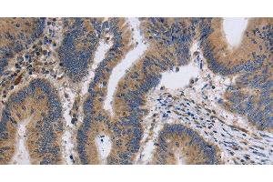 Immunohistochemistry of paraffin-embedded Human colon cancer tissue using ITPR1 Polyclonal Antibody at dilution 1:40