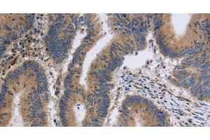 Immunohistochemistry of paraffin-embedded Human colon cancer tissue using ITPR1 Polyclonal Antibody at dilution 1:40 (ITPR1 抗体)